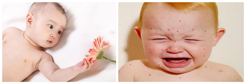 兒童濕疹反反復復，您有在家安裝家用除濕產品嗎？